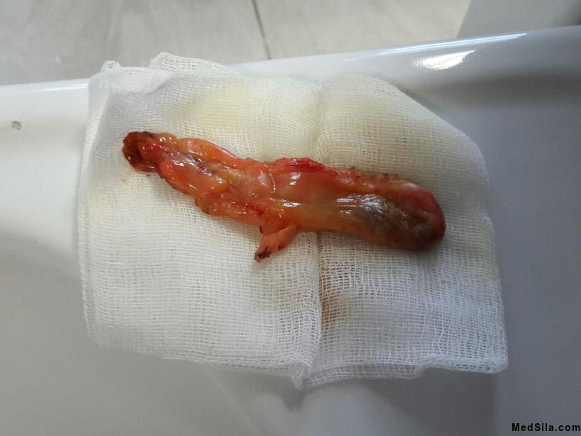 Удаленный желчный пузырь